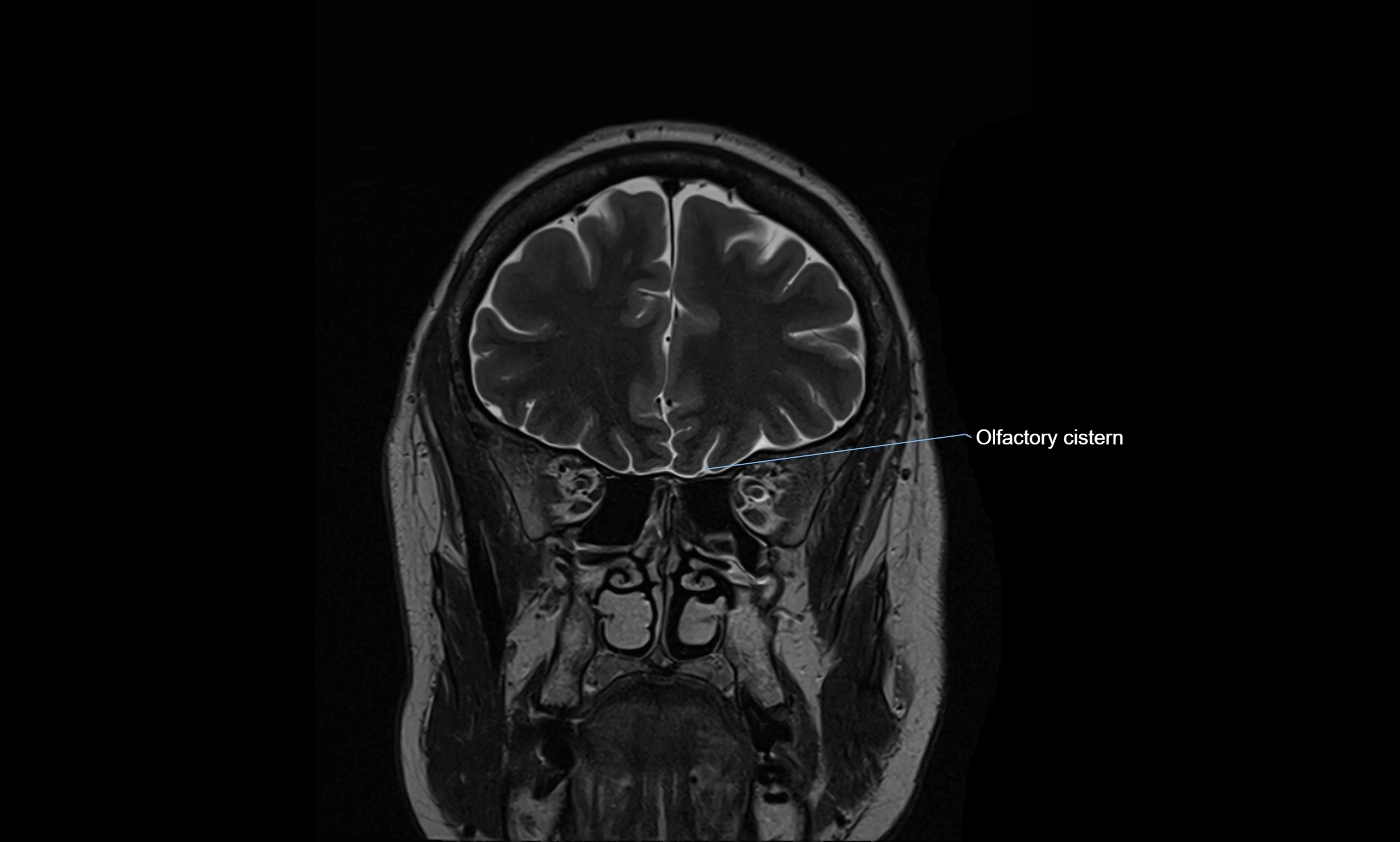 Brain cisterns  and ventricles coronal anatomy 3T MRI image-img-00001-00011.webp